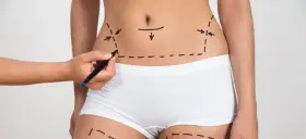 Rysowanie linii na brzuchu i udach, planowanie zabiegu. Zastanawiasz się, ile kosztuje liposukcja?