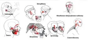 Punkty spustowe w obrębie stawów skroniowo żuchwowych: policzkowy, skrzydłowy, żwacz, skroniowy, jarzmowy, mostkowo-obojczykowo-sutkowy, czworoboczny.