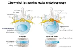 Pęknięcie pierścienia włóknistego objawy: przepuklina jądra miażdżystego uciska korzeń nerwowy, powodując zwężenie kanału kręgowego.