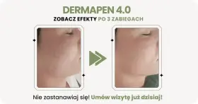 Dermapen 4.0 na co? Zobacz efekty po 3 zabiegach: skóra wygładzona, bez niedoskonałości. Umów wizytę!