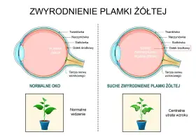 Porównanie normalnego oka z suchym zwyrodnieniem plamki żółtej. Obrazek pokazuje, jak obrzęk plamki żółtej wpływa na widzenie.
