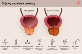 Porównanie zdrowej prostaty i zapalenia prostaty. Objawy zapalenia prostaty: słaby strumień moczu, ból, pieczenie, zaburzenia erekcji.