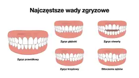 Ilustracja pokazuje różne rodzaje wad zgryzu: prawidłowy, głęboki, otwarty, krzyżowy i stłoczenia. Prawidłowa okluzja jest kluczowa dla zdrowia jamy ustnej.