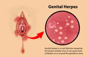 Illustrazione di herpes vaginale con lesioni e ingrandimento del virus.