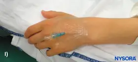 Ein Zugang am Handrücken, wo tut ein zugang am wenigsten weh? Hier wird ein Infusionsschlauch an einer Hand befestigt.