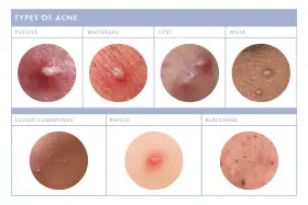 Close-up images show various types of acne, including pustules, whiteheads, cysts, milia, closed comedones, papules, and blackheads. Some show small white bumps on the face.
