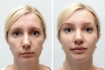 Przed i po zabiegu osoczem bogatopłytkowym. Skóra twarzy wygładzona, zmarszczki zredukowane, cera promienna.