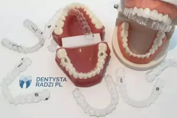 Aparat ortodontyczny efekty po 2 miesiącach. Przezroczyste nakładki na zęby i modele szczęk pokazują postęp leczenia.