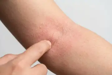Rote, trockene Haut am Arm, die auf Neurodermitis hindeutet. Eine Hand berührt die betroffene Stelle, um zu zeigen, was hilft gegen Neurodermitis.