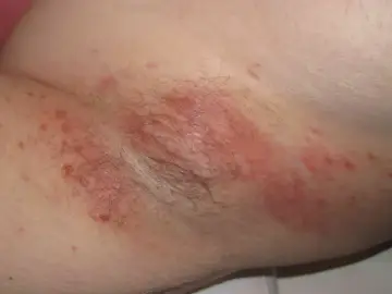 Skóra pod pachami zaczerwieniona, z widocznymi zmianami, wskazującymi na odparzenia.