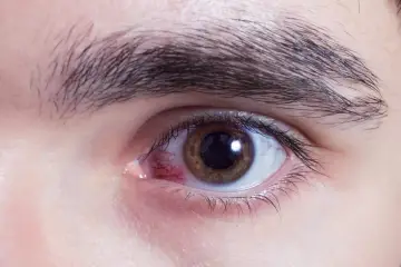 Occhio con sclera arrossata e iride marrone, suggerisce un'abrasione corneale dovuta a occhio secco.