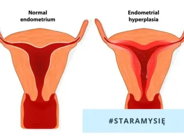 Porównanie prawidłowego endometrium z jego przerostem. Biopsja endometrium jest kluczowa w diagnostyce.