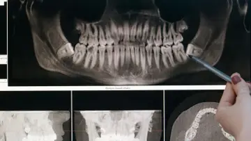 Dentyści analizują prześwietlenie szczęki, wskazując na problem z zębami.