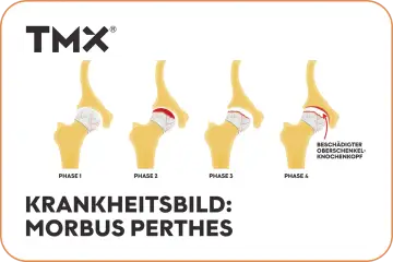 Illustration von 4 Phasen des Morbus Perthes am Hüftgelenk.
