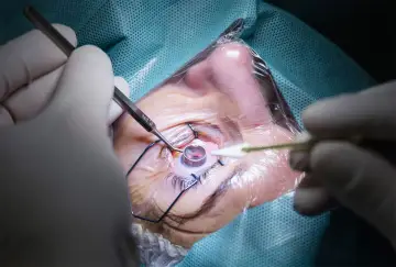 Chirurg podczas zabiegu laserowej korekcji wzroku. Od ilu lat można poddać się tej procedurze?
