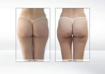 Endermologia: Ile cm stracisz? Realne efekty i wskazówki