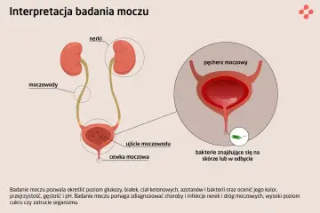 Ilustracja układu moczowego z zaznaczonymi nerkami, moczowodami i pęcherzem. Powiększenie pokazuje bakterie w pobliżu ujścia cewki moczowej, sugerując obecność bakterii w moczu.
