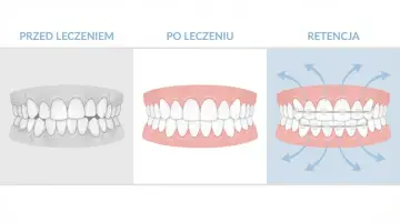 Przed leczeniem krzywe zęby, po leczeniu proste, a retencja to aparat utrzymujący efekt.