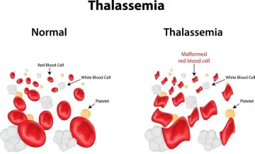 Choroby hematologiczne objawy: nie bagatelizuj tych sygnałów zdrowotnych