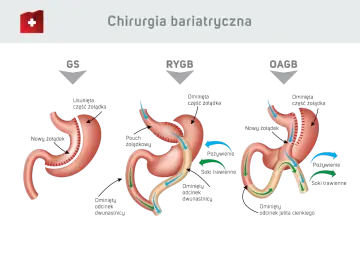 Ilustracja porównuje trzy typy operacji bariatrycznych: GS, RYGB, OAGB. Dowiedz się, ile kosztuje operacja bariatryczna i jakie są jej rodzaje.