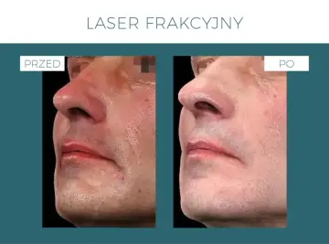 Przed i po zabiegu laserem frakcyjnym. Widoczne zmiany w teksturze skóry, redukcja zaczerwienień. Laser frakcyjny skutki uboczne są minimalne.