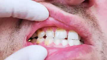 Usta z widocznym ukruszonym zębem, żółtymi przebarwieniami i zarostem. Dłoń w białej rękawiczce odsłania uzębienie.