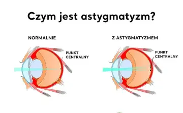 Astygmatyzm: okulary czy soczewki? Porównaj i wybierz mądrze!