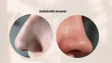 Zbliżenie na nos z widocznymi zaskórnikami otwartymi. Dwa okręgi ukazują różne tekstury skóry i pory.