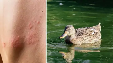 Haut mit roten Pusteln, die auf einen Zerkarien Ausschlag hindeuten, neben einer Ente im Wasser.