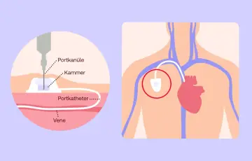Illustration zeigt eine Portkanüle, die in eine Vene eingeführt wird, um Chemotherapie zu verabreichen.