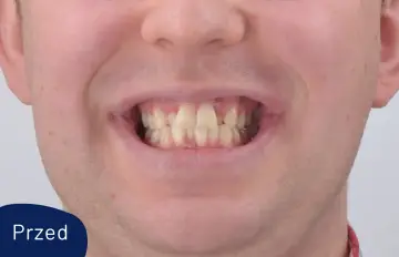 Uśmiech przed leczeniem Invisalign. Widoczne nierówne i lekko pożółkłe zęby.