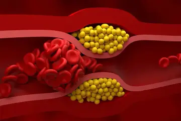 Zator w naczyniu krwionośnym: czerwone krwinki i żółte złogi. Badanie lipoproteiny pomoże ocenić ryzyko.
