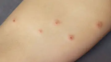 Skóra z kilkoma czerwonymi, swędzącymi zmianami, które mogą być **pluskwy ugryzienia**.