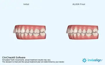 Porównanie zębów przed i po leczeniu nakładkami Invisalign. Widoczna poprawa zgryzu dzięki technologii ClinCheck.