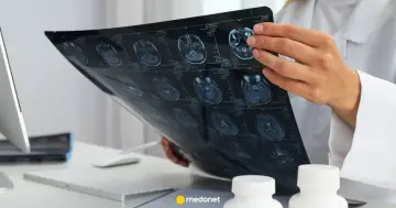 Lekarz analizuje obraz rezonansu magnetycznego mózgu, szukając oznak glejaka.
