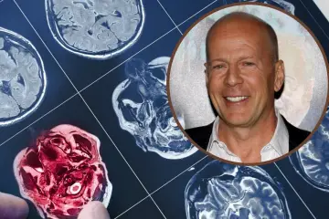 Bruce Willis choroba: obraz rezonansu magnetycznego mózgu obok uśmiechniętej twarzy aktora.