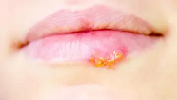 Pęcherzyki na ustach, objaw **herpes**, zaczerwienienie i strupki.