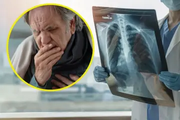 Starszy mężczyzna kaszle, trzymając się za klatkę piersiową. Lekarz w rękawiczkach pokazuje zdjęcie rentgenowskie płuc, sugerując włóknienie płuc pierwsze objawy.