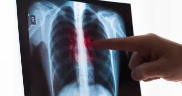 RTG klatki piersiowej z zaznaczonymi licznymi drobnymi guzkami w płucach.