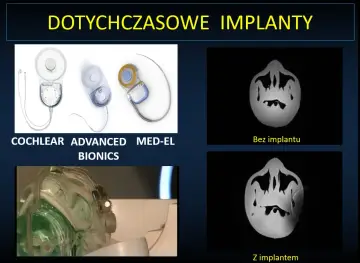 Nowoczesne implanty ślimakowe, w tym niewidoczny implant, poprawiają słuch.