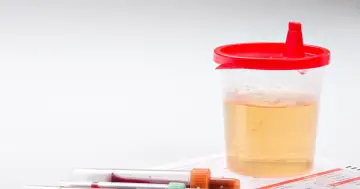 Pojemnik z żółtym płynem i próbówki z krwią. Wyniki badań wskazują na erytrocyty w moczu.