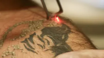 Laser usuwanie tatuażu. Czerwony promień lasera rozjaśnia ciemny wzór na skórze, rozpoczynając proces usuwania tatuażu.