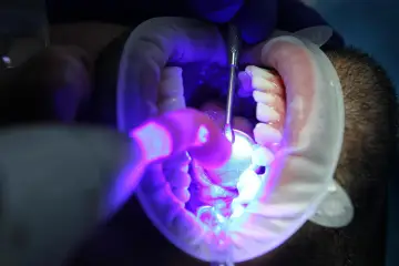 Dentysta utwardza światłem lampy nowe plomby w jamie ustnej pacjenta.