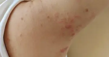 Skóra z licznymi zaczerwienionymi zmianami, w tym pojedynczymi pryszczami i skupiskami drobnych krostek.