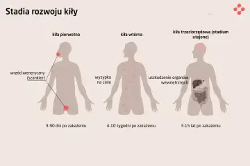 Ilustracja przedstawia stadia rozwoju kiły: pierwotne (wrzód), wtórne (wysypka) i trzeciorzędowe (uszkodzenie organów wewnętrznych, np. mózgu i wątroby).