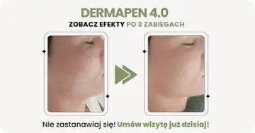 Dermapen 4.0 na co? Zobacz efekty po 3 zabiegach: skóra wygładzona, bez niedoskonałości. Umów wizytę!