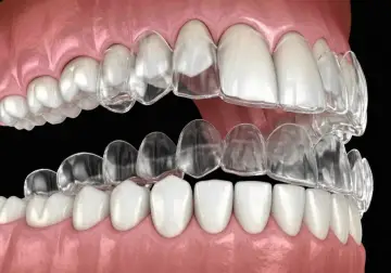 Przezroczyste nakładki na zęby, czyli invisalign co to jest? Pokazują, jak działają, delikatnie korygując zgryz.