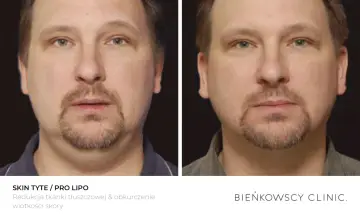 Przed i po zabiegu lipolizy: widoczna redukcja tkanki tłuszczowej i obkurczenie skóry na twarzy mężczyzny.