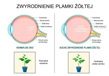 Porównanie normalnego oka z suchym zwyrodnieniem plamki żółtej. Obrazek pokazuje, jak obrzęk plamki żółtej wpływa na widzenie.