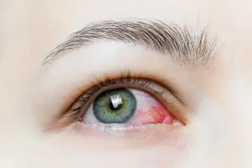 Occhio rosso e irritato, con evidente infiammazione. Possibili sintomi di infezione oculare.